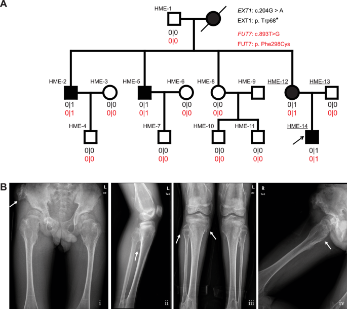 Identification of novel germline mutations in FUT7 and EXT1 linked with hereditary multiple exostoses