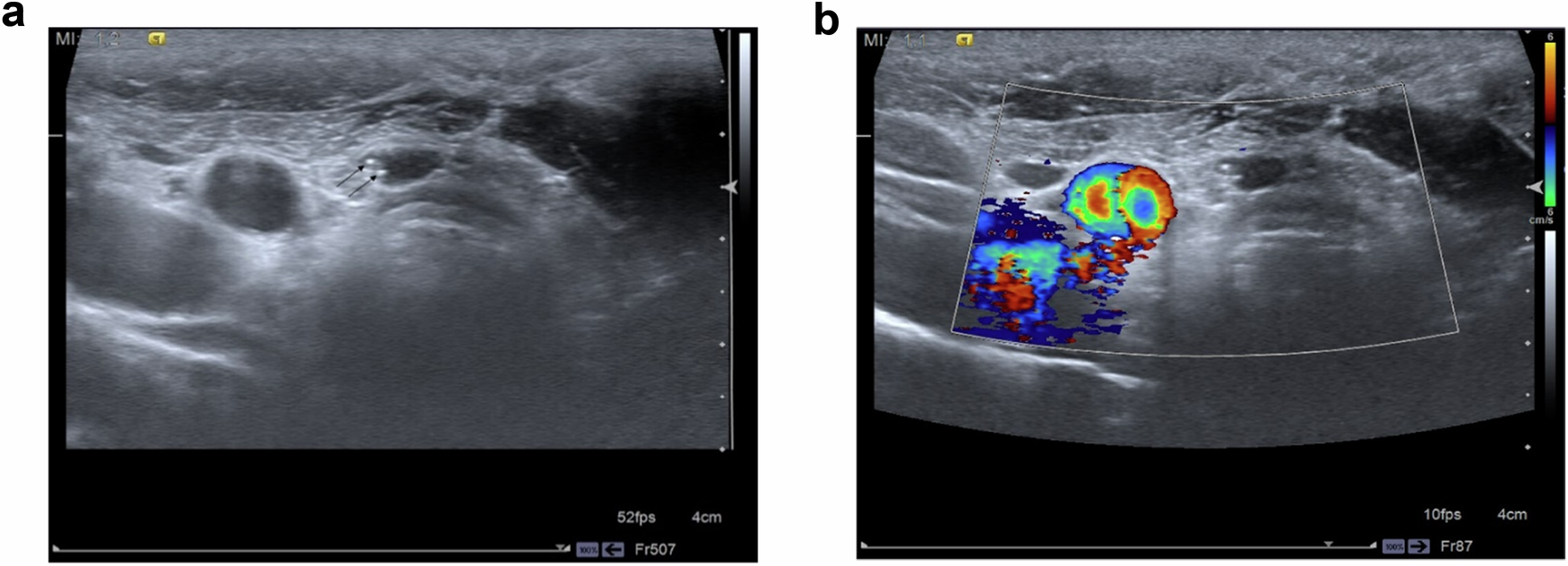 Contribution of neck ultrasonography to patient management in patients with differentiated thyroid carcinoma with excellent response to therapy