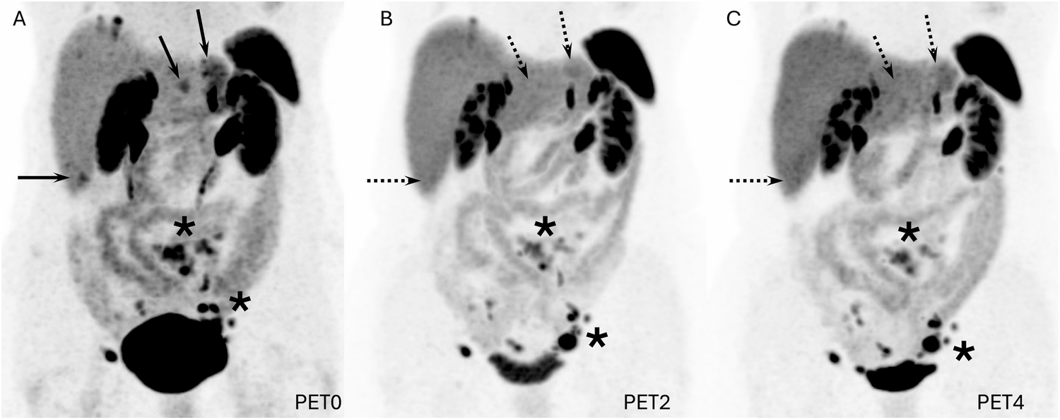 Organ-specific response to [177Lu]DOTATATE peptide receptor radionuclide therapy (PRRT) assessed by sequential [68Ga]DOTATOC PET/CT in patients with metastatic small intestine neuroendocrine tumors