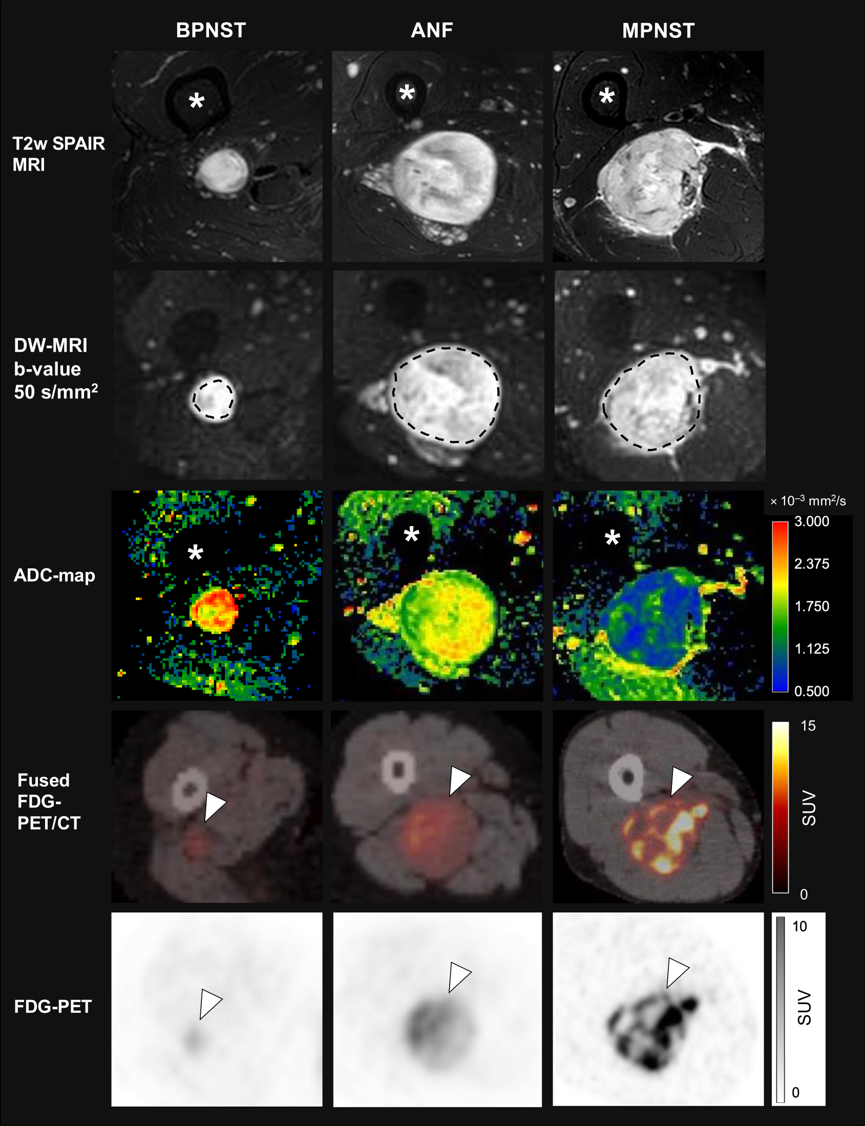 Discrimination of benign, atypical, and malignant peripheral nerve sheath tumours in neurofibromatosis type 1 – intraindividual comparison of positron emission computed tomography and diffusion-weighted magnetic resonance imaging