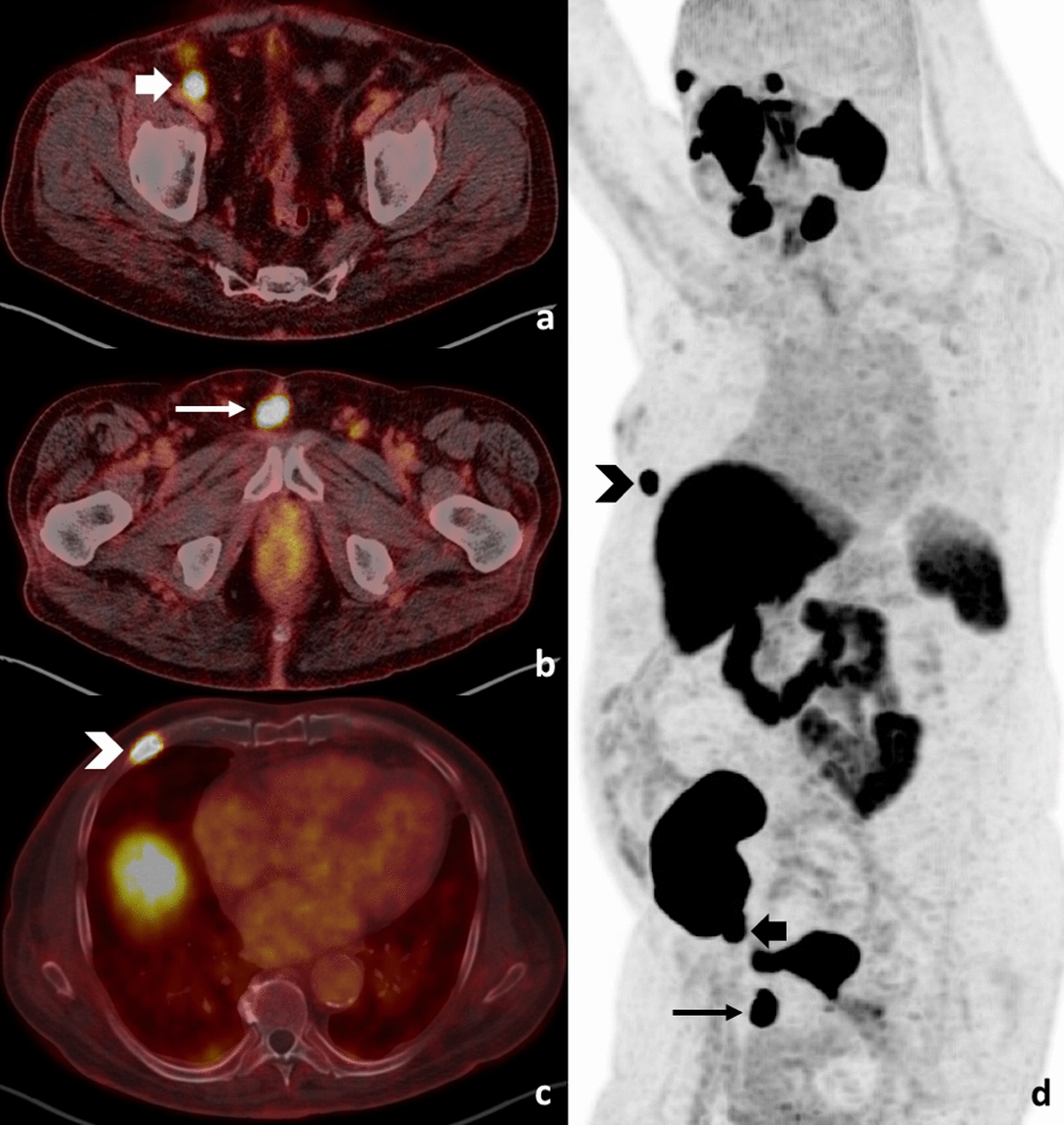 cfDNA fragmentation patterns correlate with tumor burden measured via PSMA PET/CT volumetric parameters in patients with biochemical recurrence of prostate cancer
