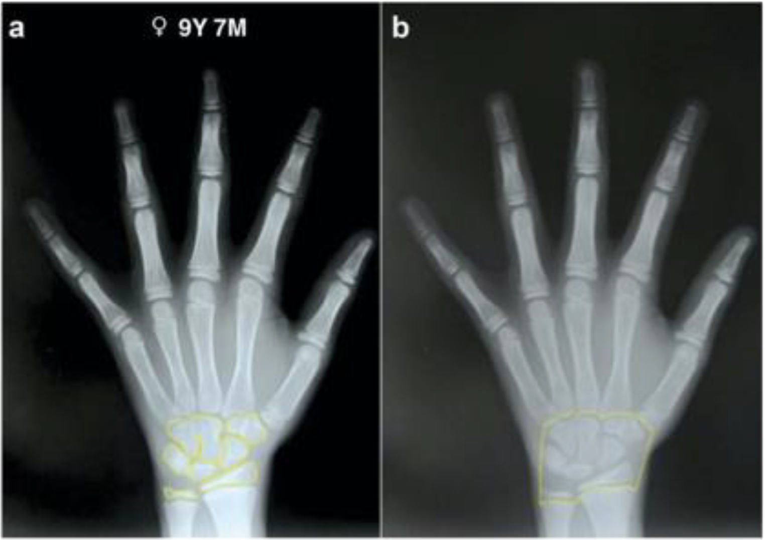Comparison of original and new South African formulae for age estimation in African Black and white children and adolescents using dental and hand-wrist methods