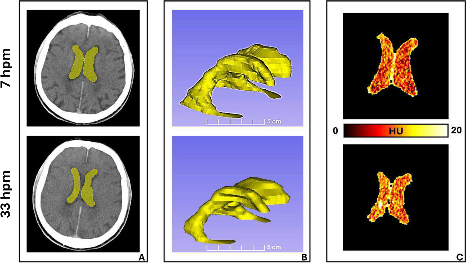 Exploring radiomic features of lateral cerebral ventricles in postmortem CT for postmortem interval estimation