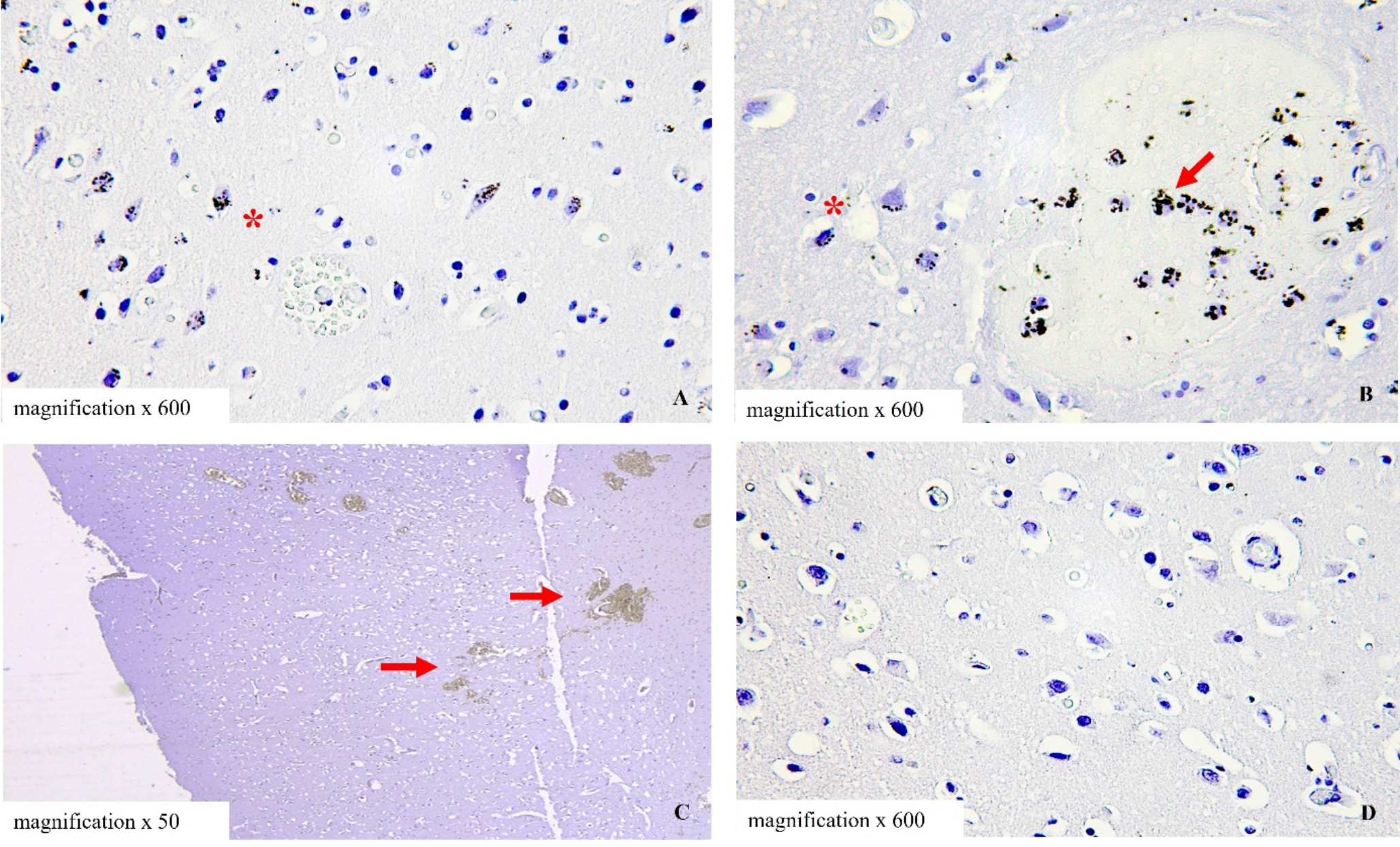 Expression of RIPK-1 and S-100B in traumatic brain injury– exploring a forensic cases series