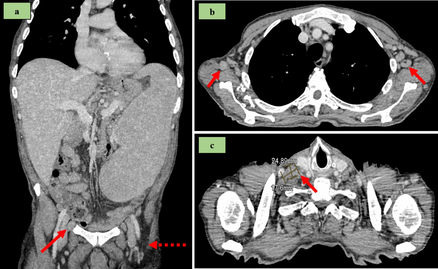 Nodal mature plasmacytoid dendritic cell proliferation mimicking lymphoma in a patient with CALR-mutated myelofibrosis