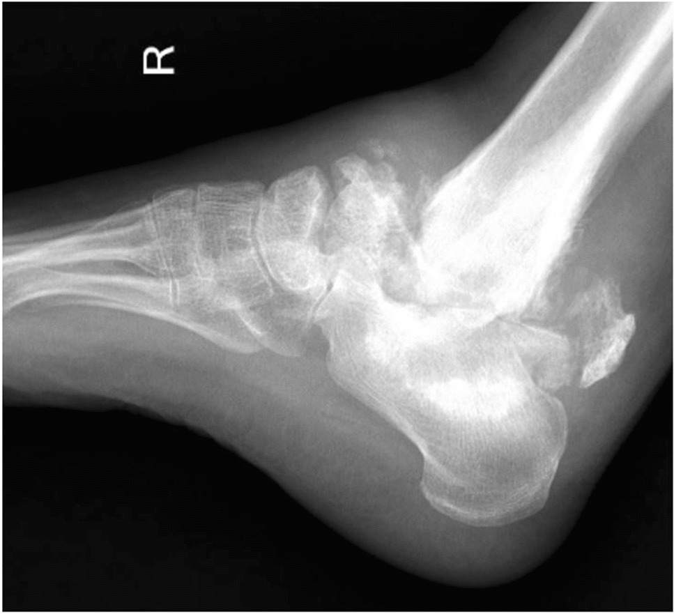 Skeletal fragility in type 1 diabetes mellitus: A rare case of avascular necrosis of talus