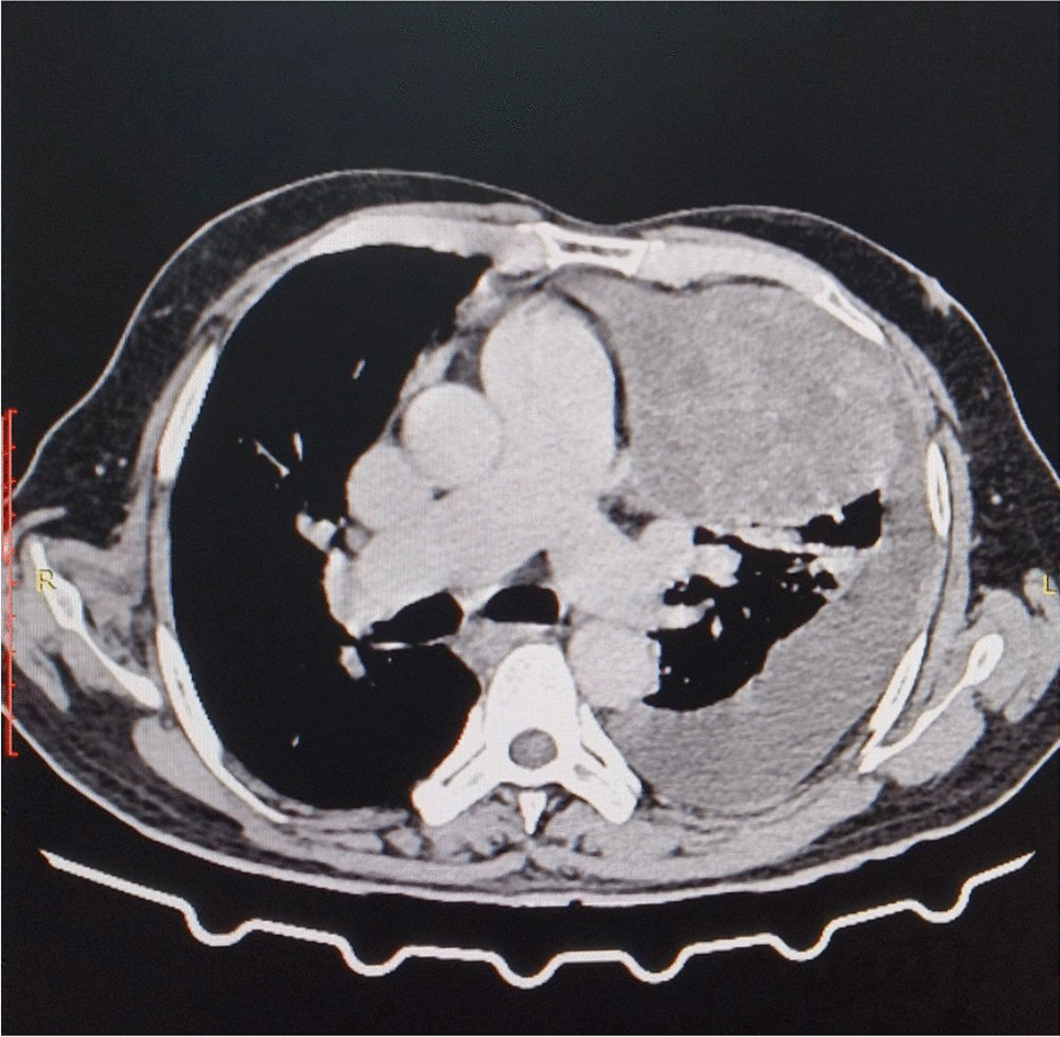 A case of autoimmune haemolytic anaemia associated with mediastinal teratoma