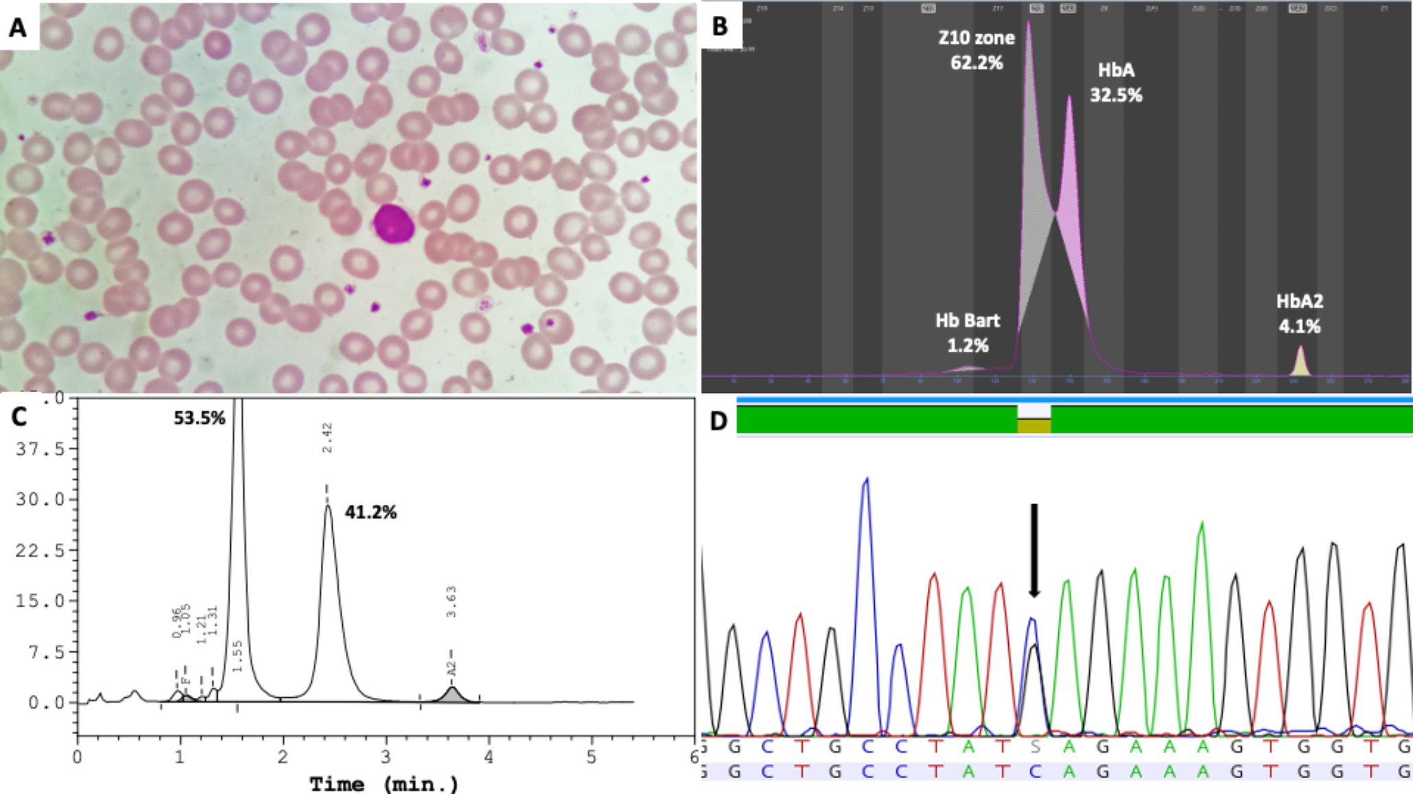 Kissing Triangles: A Peculiar Pattern of Hemoglobin Camden in Capillary Zone Electrophoresis