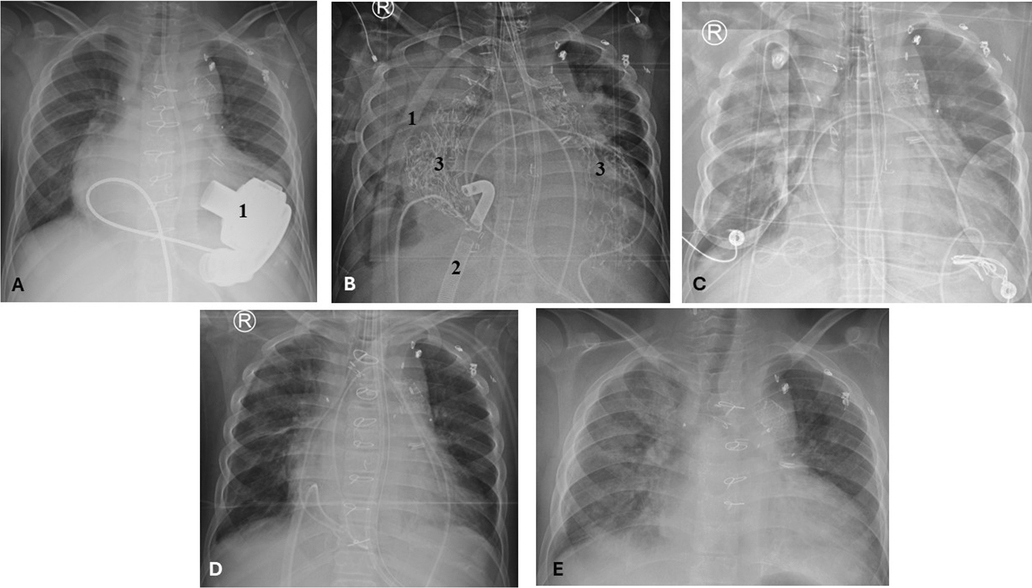 Successful pediatric heart transplantation with bivalirudin use in a cyanotic single ventricle patient with an intracorporeal continuous flow ventricular assist device and heparin-induced thrombocytopenia