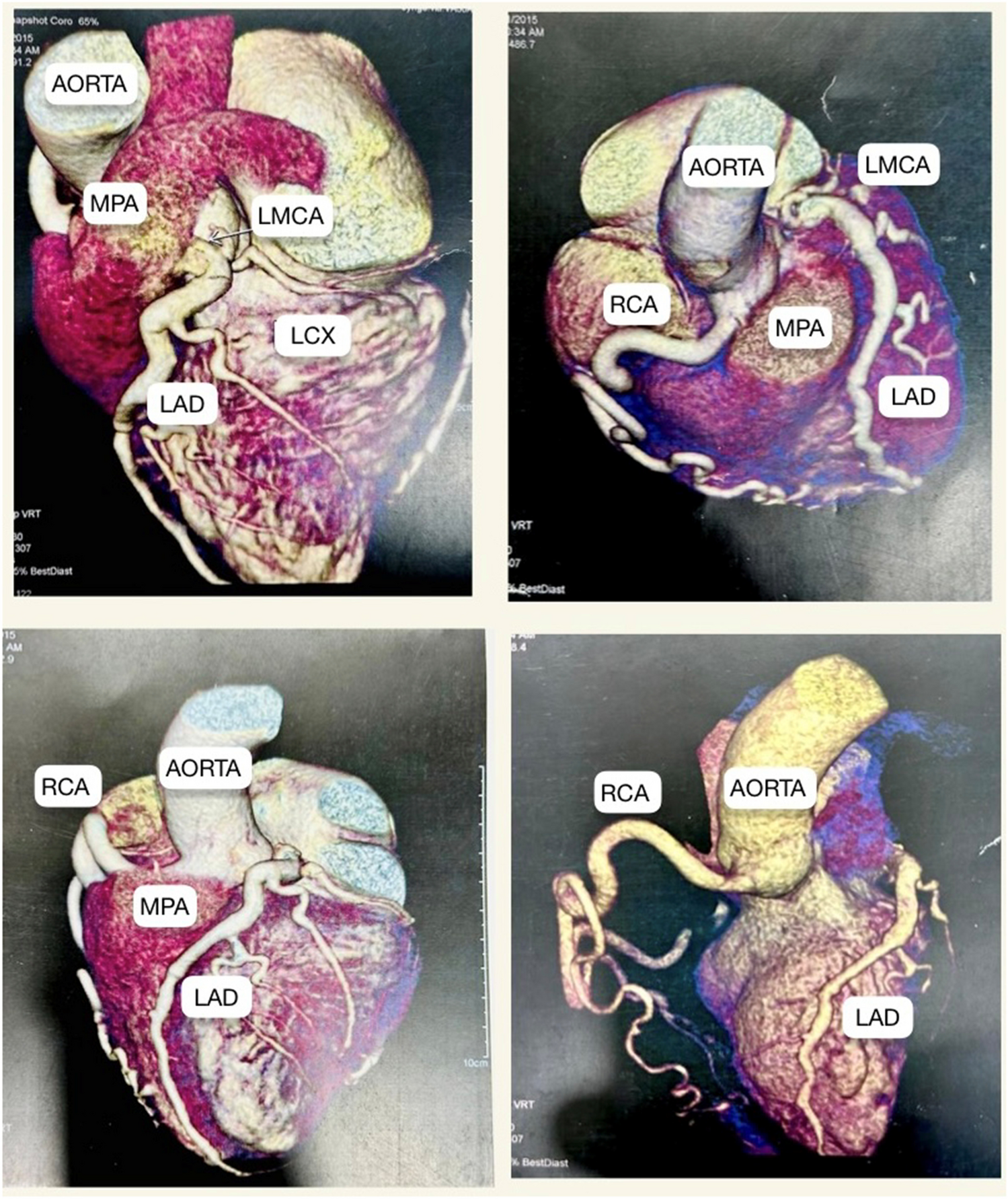 The midterm outcomes of coronary artery bypass grafting for adult anomalous origin of the left coronary artery from the pulmonary artery