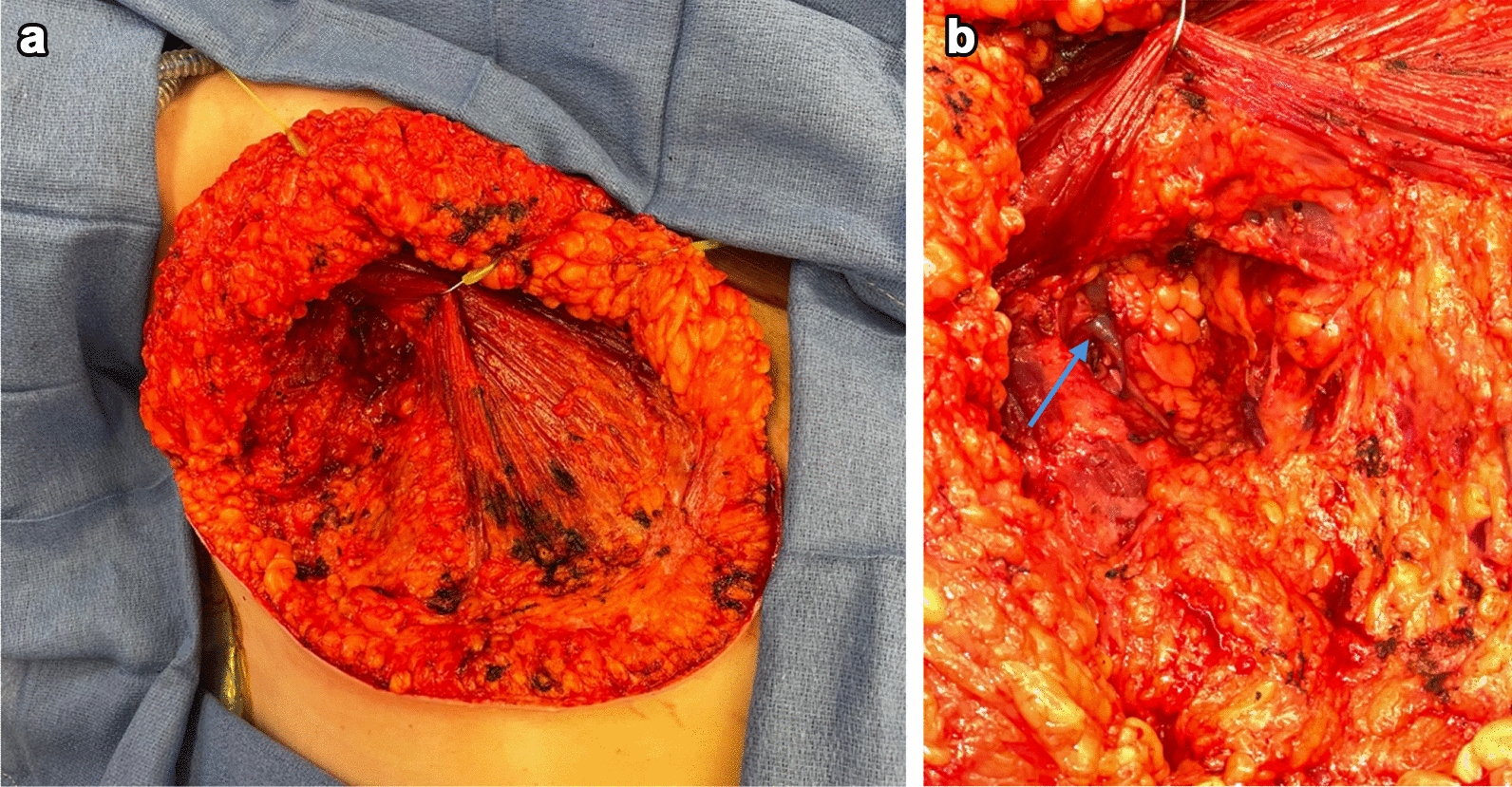 Immediate Lymphatic Reconstruction: An Overview and Current Evidence