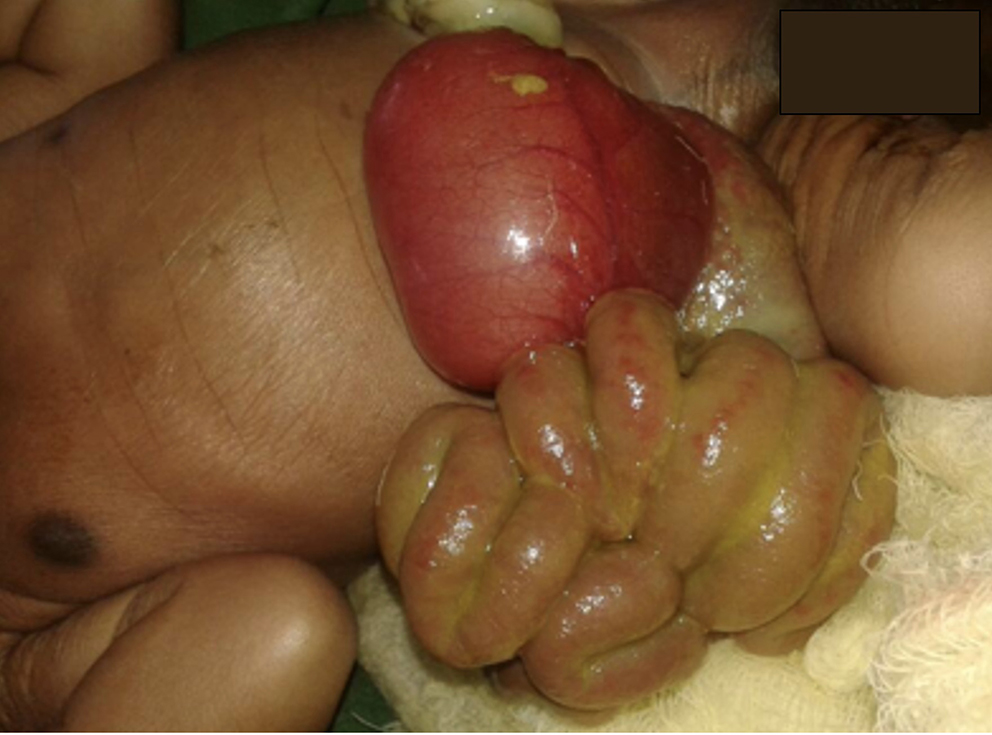 Challenges and Adaptations for Neonatal Surgical Care in LMICs: The Rwandan Gastroschisis Experience