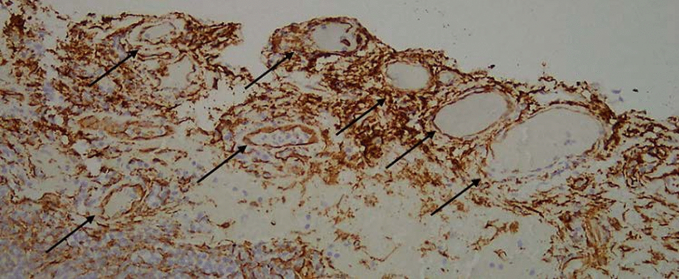Effects of ranibizumab on microvasculature, oxidative stress and recurrence in primary pterygium surgery