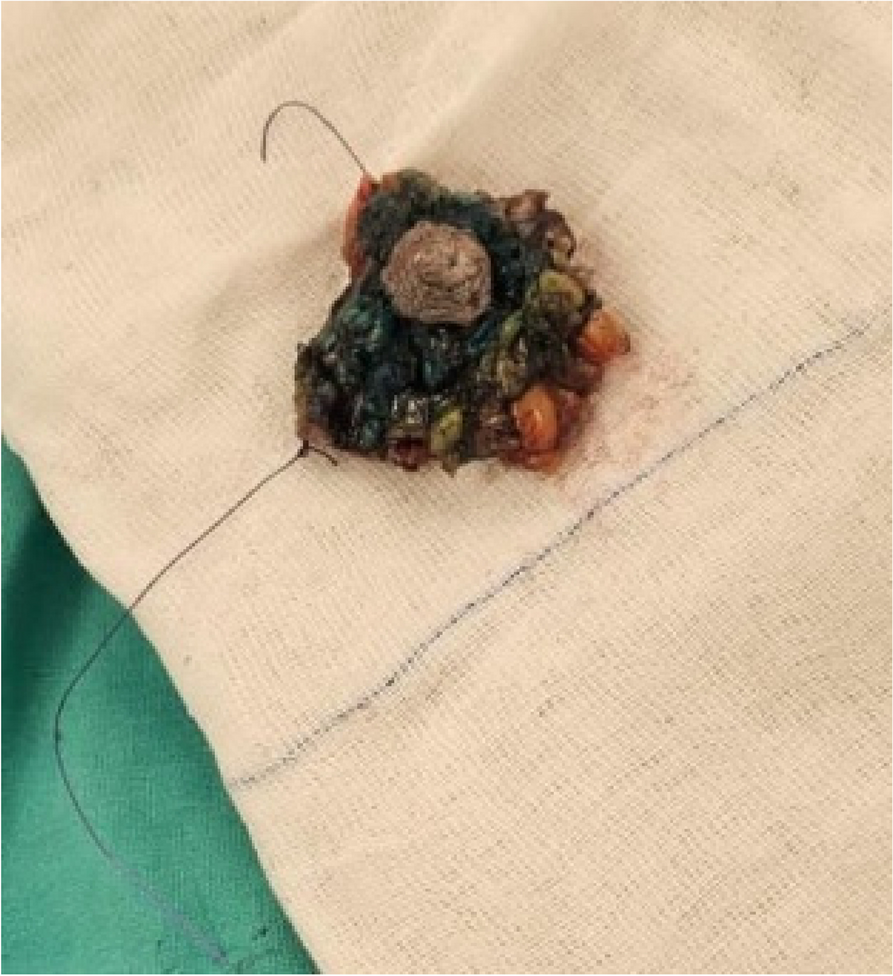 A comparative study between central quadrantectomy and nipple resection with areola preservation Versus Grisotti flap mammoplasty in central breast lesions extending to nipple: a randomized clinical trial