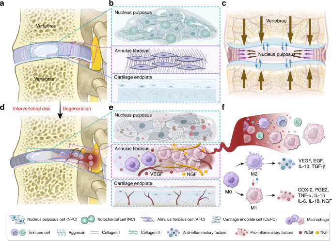 Role of macrophage in intervertebral disc degeneration