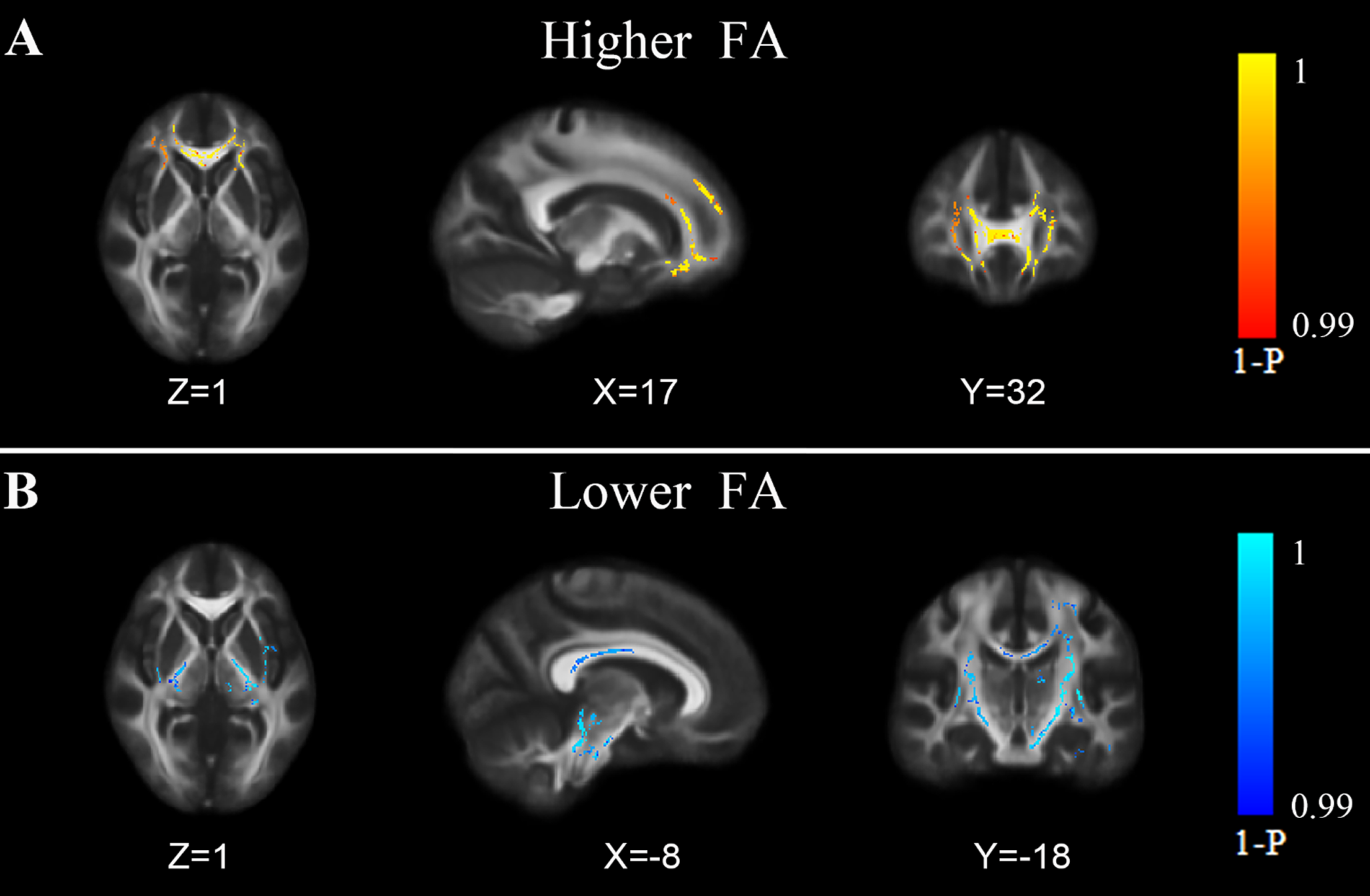Anterior and posterior cerebral white matter show different patterns of microstructural alterations in young adult smokers