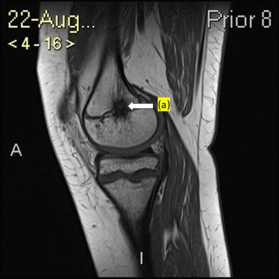 Base of Skull & Spinal Canal Narrowing in an Adolescent with Autosomal Recessive Hypophosphatemic Rickets Type 2