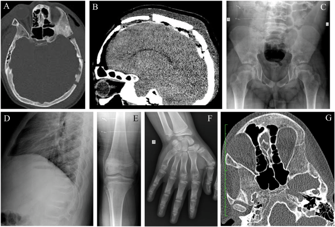 A novel missense pathogenic variants of TMEM53 in an Iranian family with craniotubular dysplasia, Ikegawa type