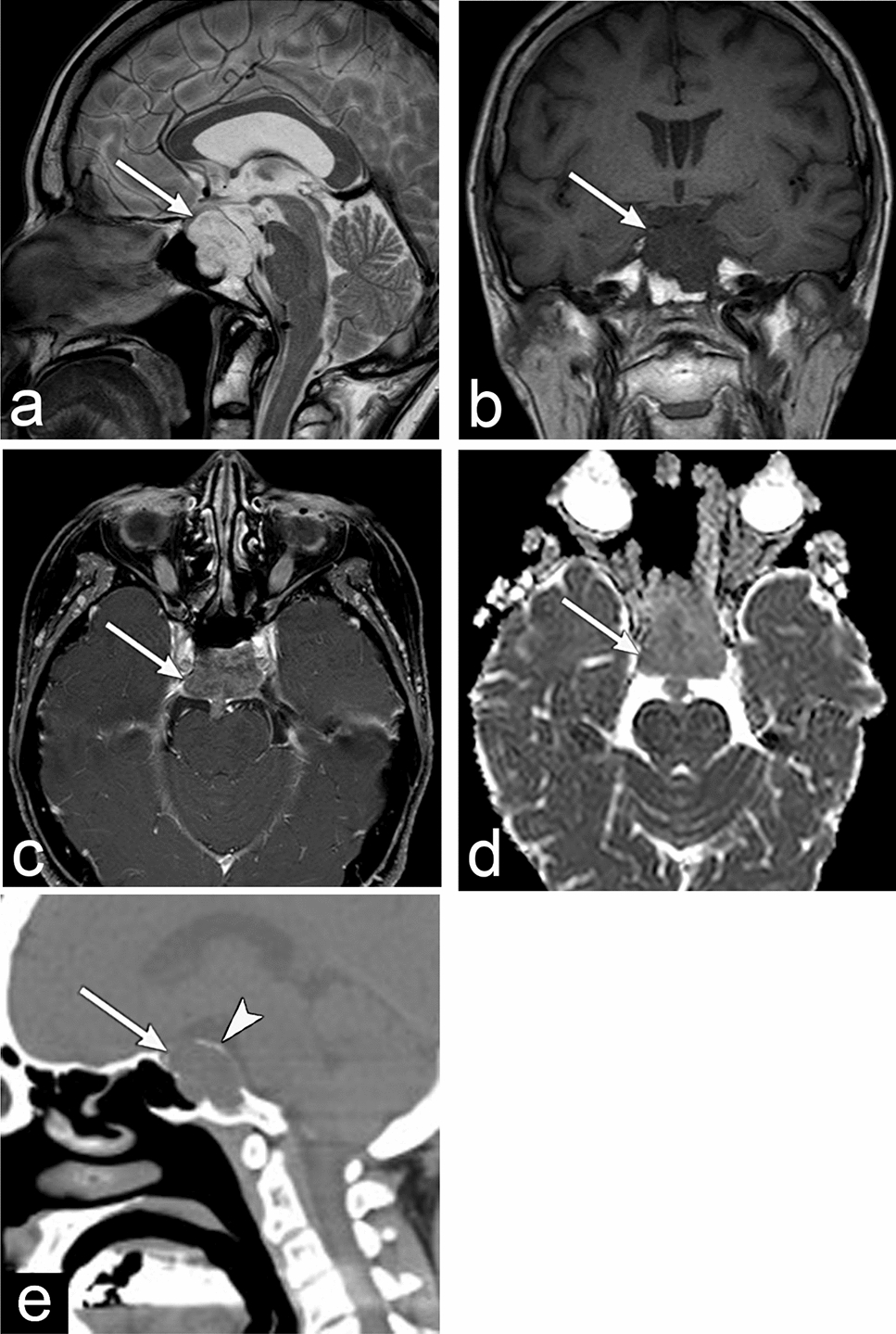 Imaging of the skull base and orbital tumors