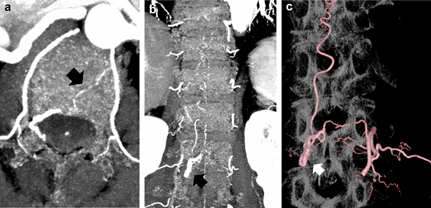 Cranial and spinal computed tomography (CT) angiography with photon-counting detector CT: comparison with angiographic and operative findings