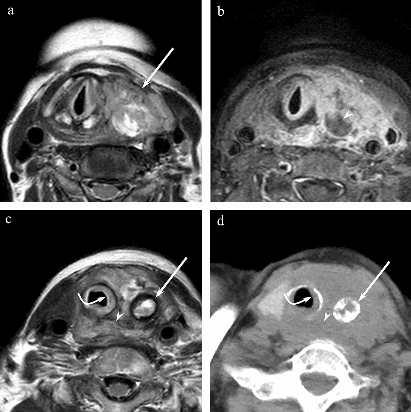 MRI features of histological subtypes of thyroid cancer in comparison with CT findings: differentiation between anaplastic, poorly differentiated, and papillary thyroid carcinoma