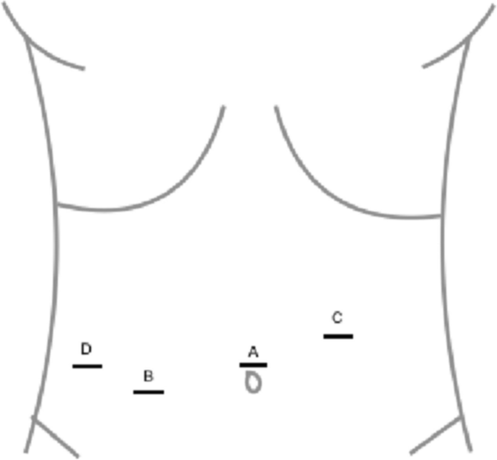 Single-surgeon training of 14 novice surgeons in robotic cholecystectomy: a study of 300 consecutive cases, assessing training outcomes and surgical performance