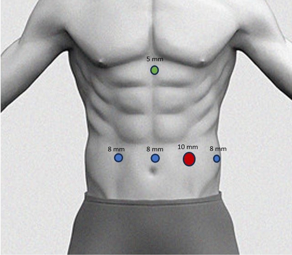 Robotic hiatus hernia surgery: learning curve and lessons learned
