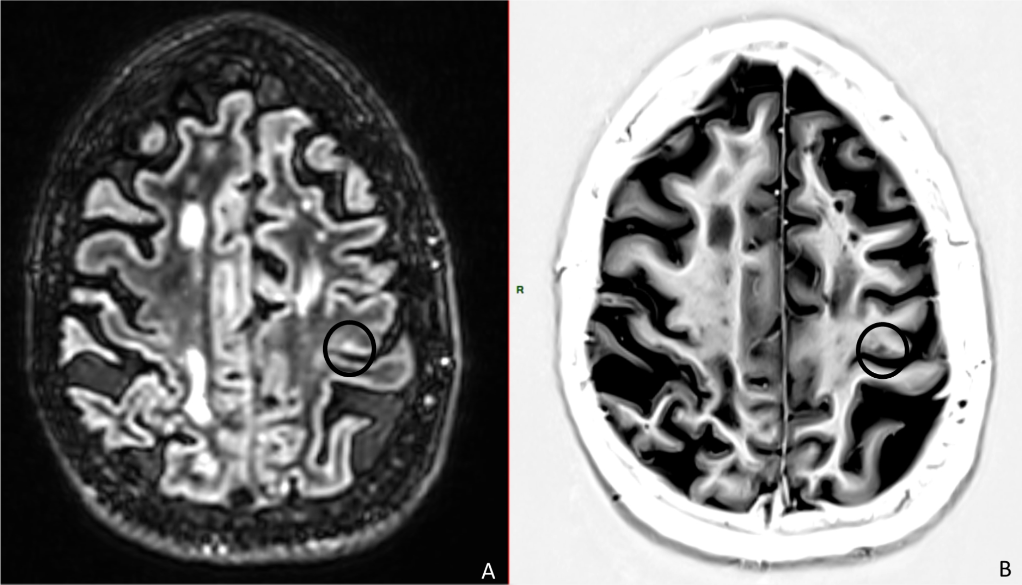 The corticospinal tract in multiple sclerosis: correlation between cortical excitability and magnetic resonance imaging measures
