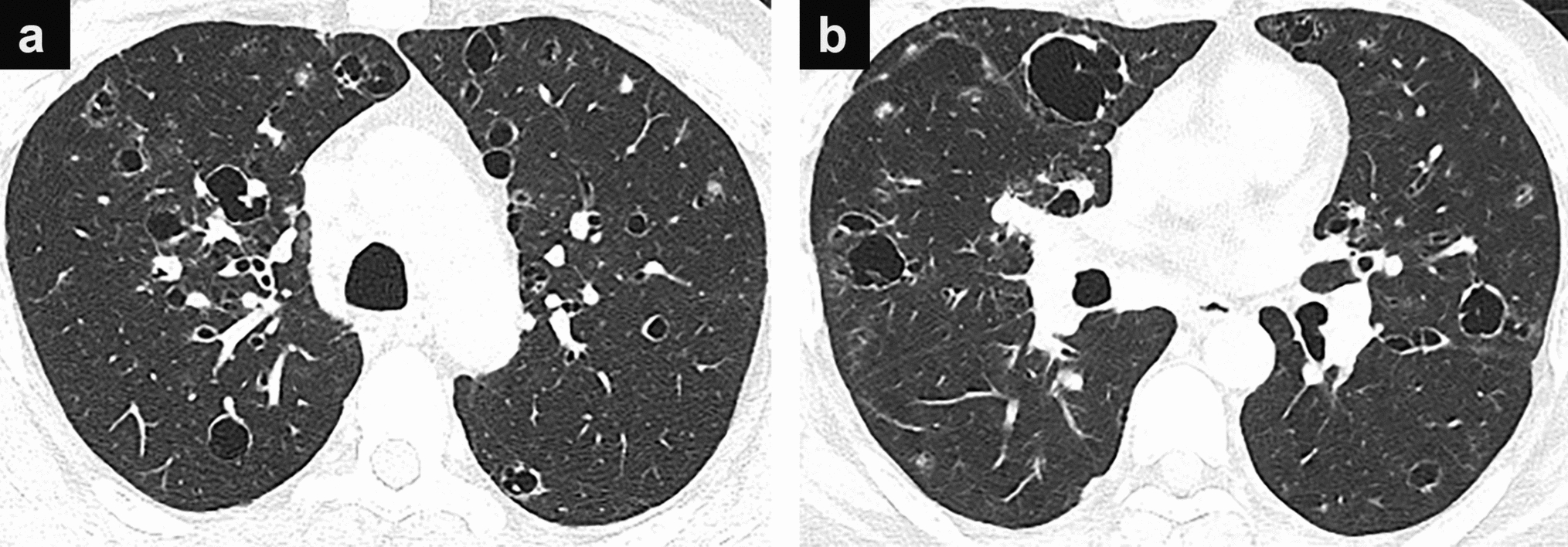 Clinical and Radiologic Differences in Lung Involvement Between IgG4-Related Disease and Plasma Cell-Type Idiopathic Multicentric Castleman Disease