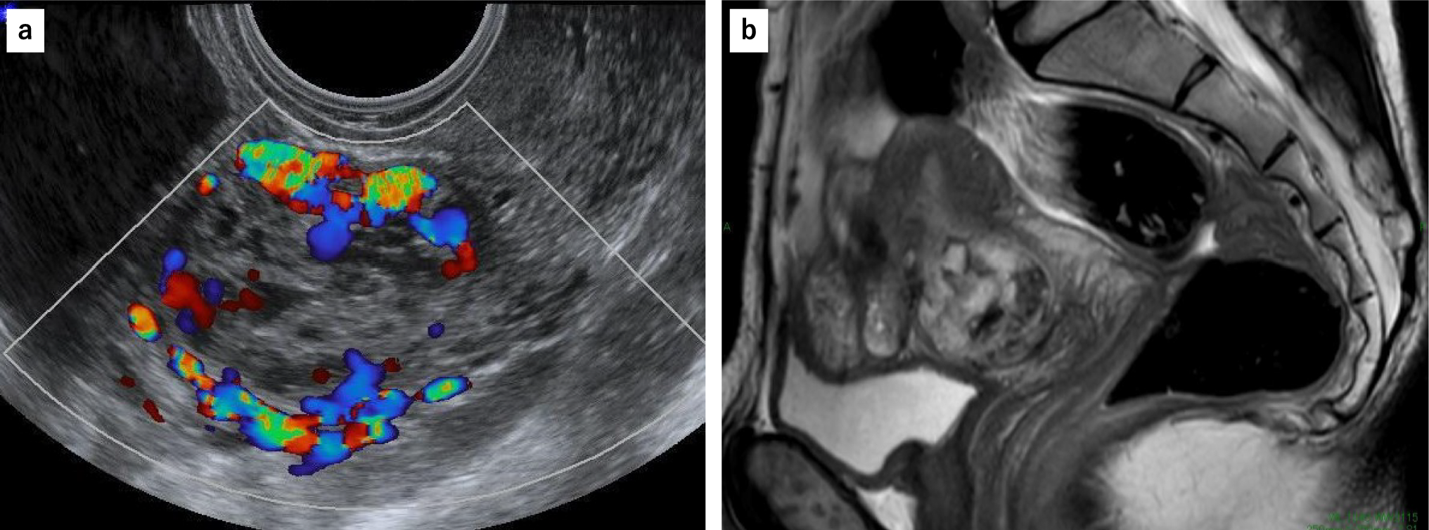 Vascular retained products of conception at cesarean scar mimicking hydatidiform mole