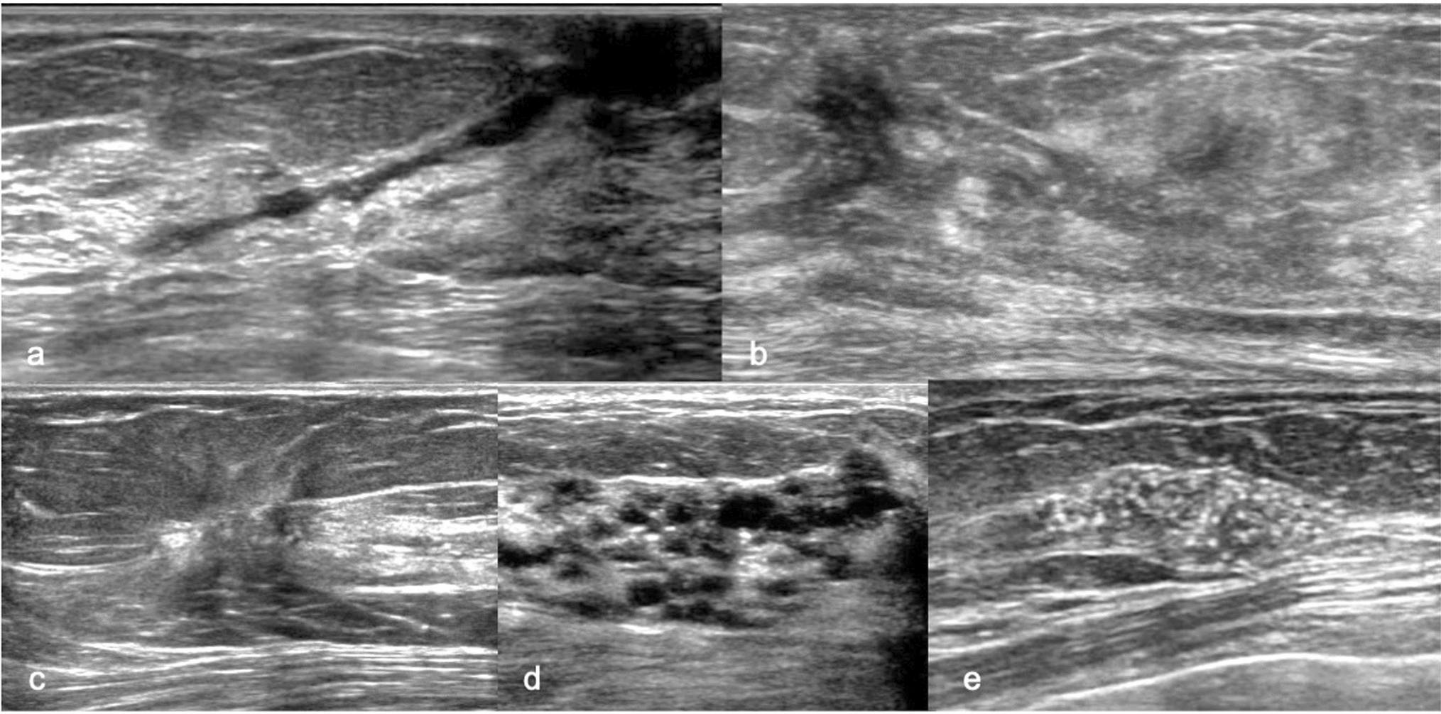 Usefulness of color Doppler and strain elastography adjunctive to B-mode ultrasonography in the diagnosis of non-mass abnormalities of the breast: results of the BC-07 multicenter study of 385 cases