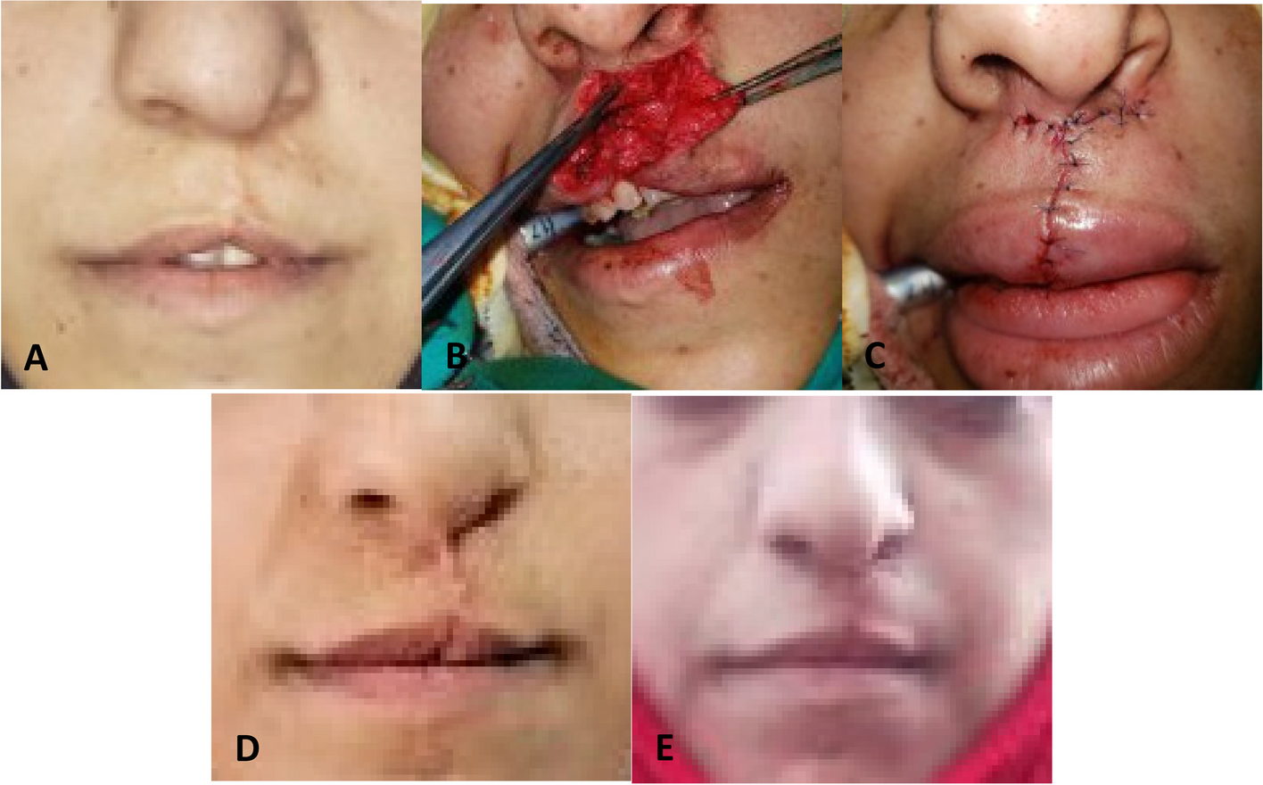 Treatment outcomes of two surgical techniques in secondary reconstruction of unilateral cleft lip and ala nasi utilizing anthropometry assessment: a randomized controlled trial