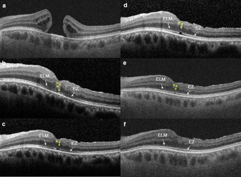 Long-term outcomes and prognosis in vitrectomy with autologous platelet concentrate injection for large, high myopic, or recurrent macular holes
