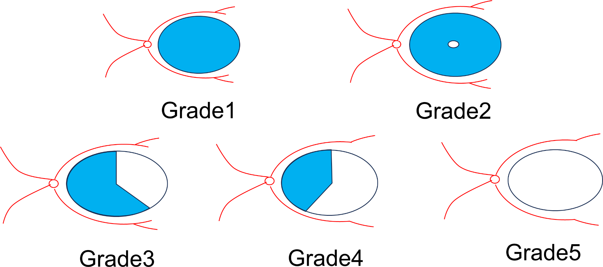 Correlation between internal limiting membrane preservation and sub-epiretinal membrane space during epiretinal membrane surgery