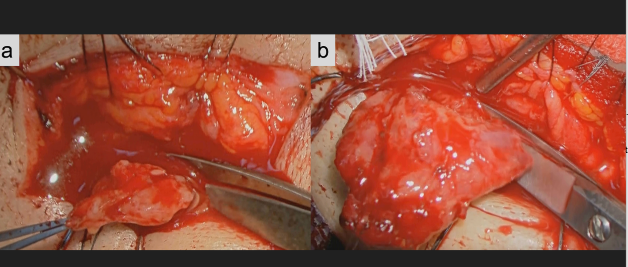 Postoperative outcomes of biopsy versus debulking surgery for immunoglobulin G4-related ophthalmic disease: a retrospective comparative study