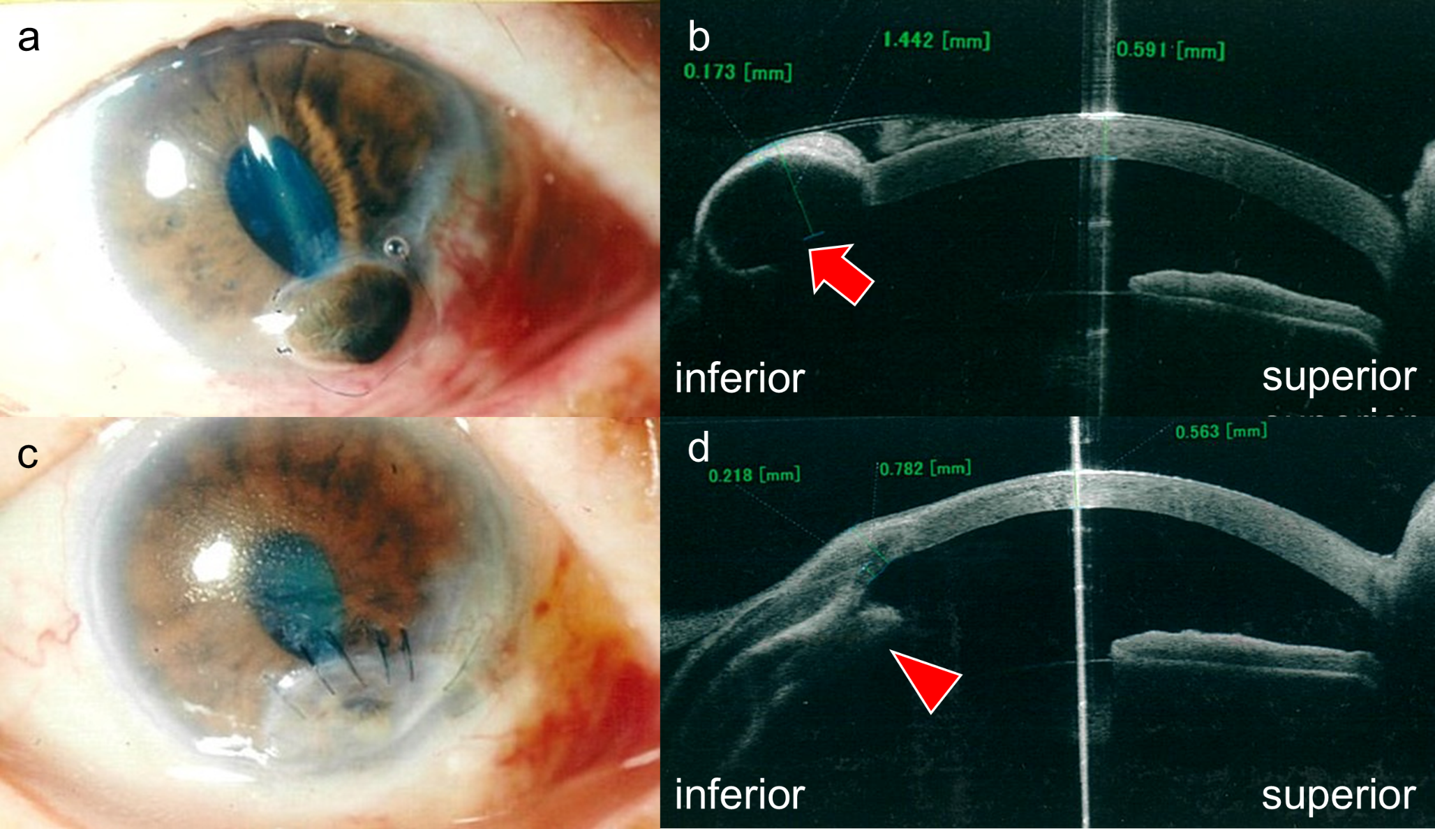 Incidence of corneal perforation and lagophthalmos in patients with leprosy in Japan based on 40-year observations