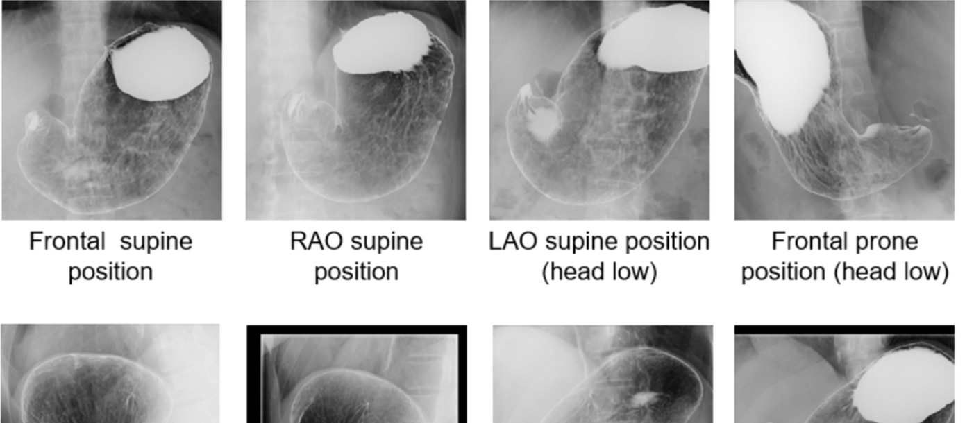Estimating the Amount of Air Inside the Stomach for Detecting Cancers on Gastric Radiographs Using Artificial Intelligence: an Observational, Cross-sectional Study