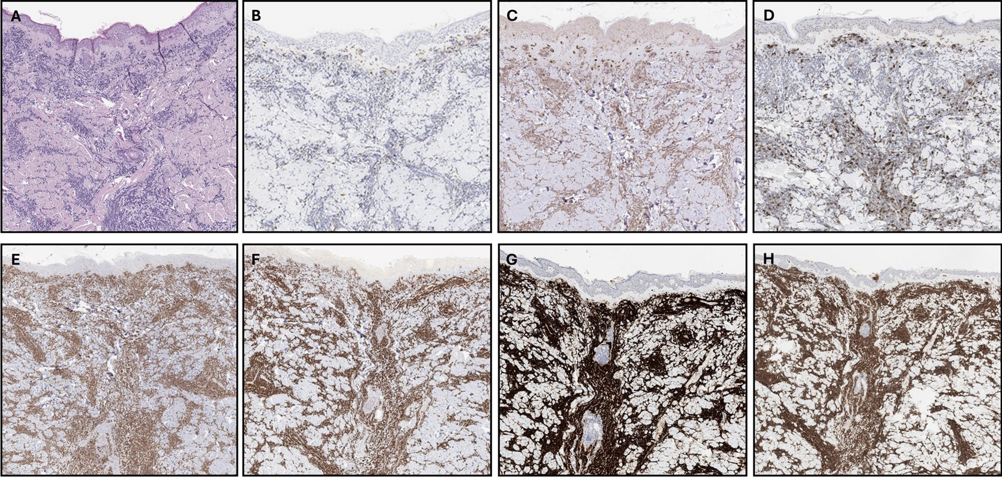 CD3/CD20/CD45 negative leukemia cutis