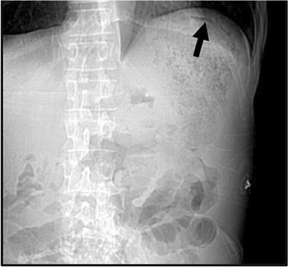 Primary gastric T-cell lymphoma presenting with perforation: a case report and review of the literature