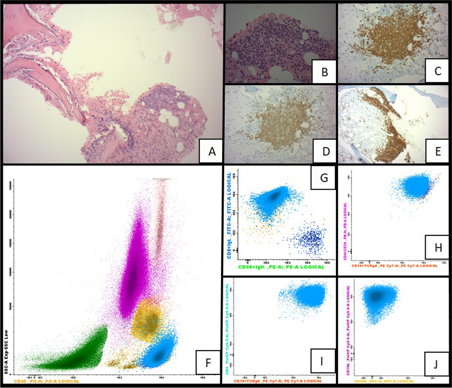 Paraneoplastic glomerulonephritis and kidney infiltration by mantle cell lymphoma: A diagnostic challenge