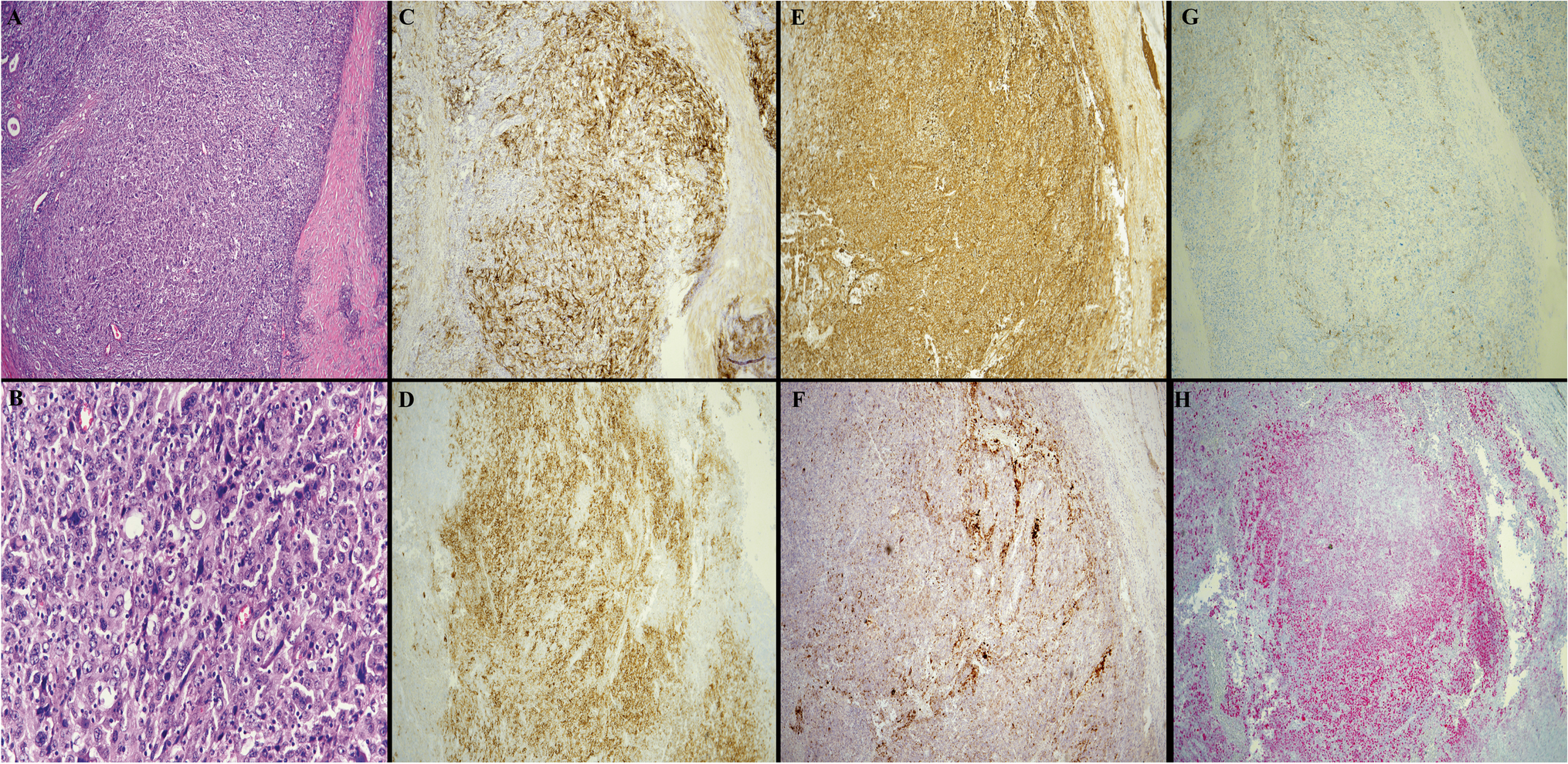 Follicular dendritic cell sarcoma involving the parotid gland with expression of the melanocytic marker PRAME