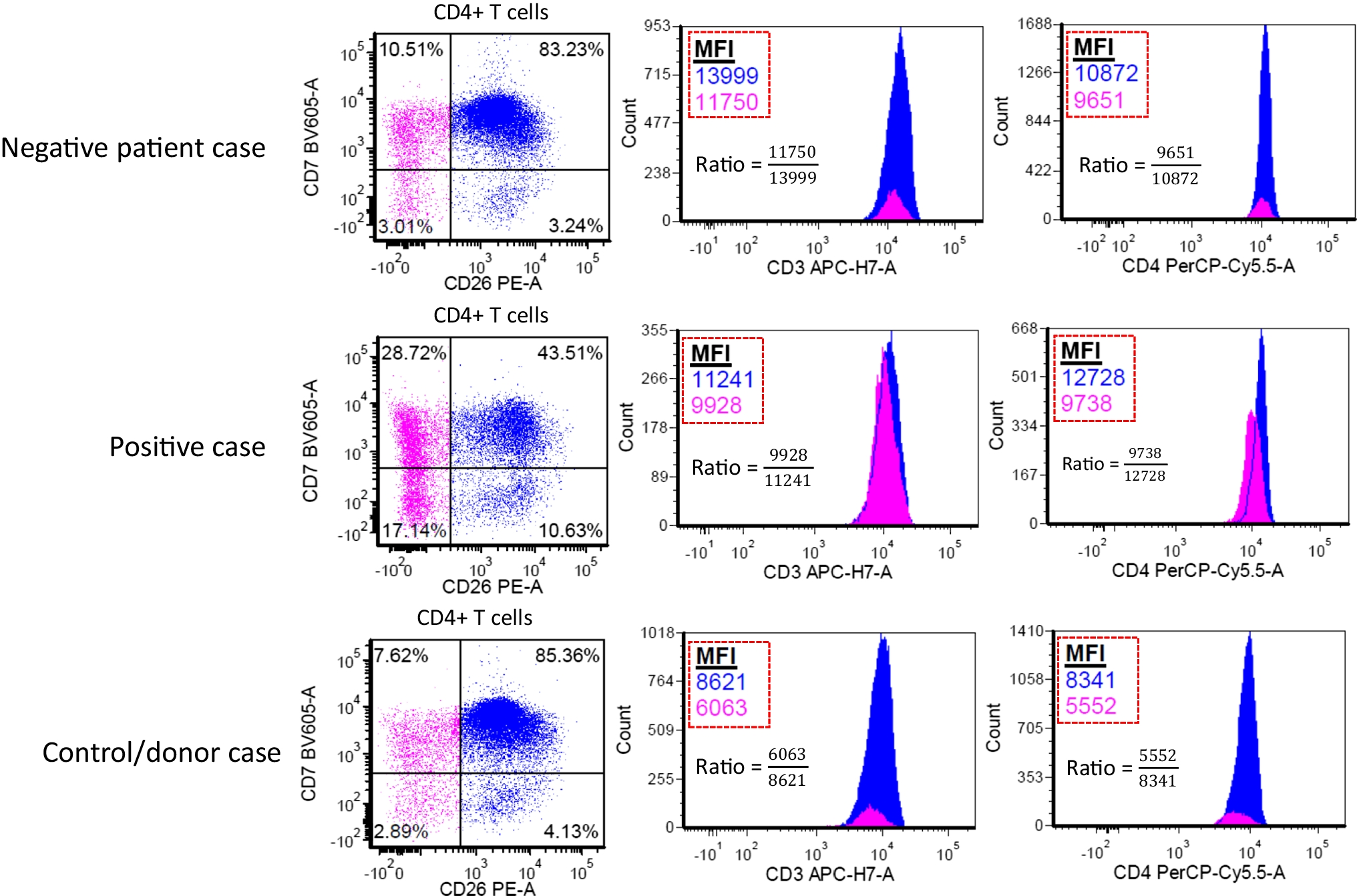 Quantification of the median fluorescence intensity of CD3 and CD4 in mycosis fungoides/Sezary syndrome versus non-neoplastic control cases in peripheral blood