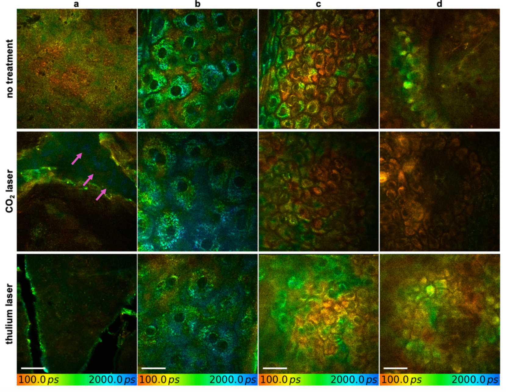 Multiphoton tomographic analysis of hyaluronic acid delivery: comparison of carbon dioxide laser and 1927 nm thulium laser over time
