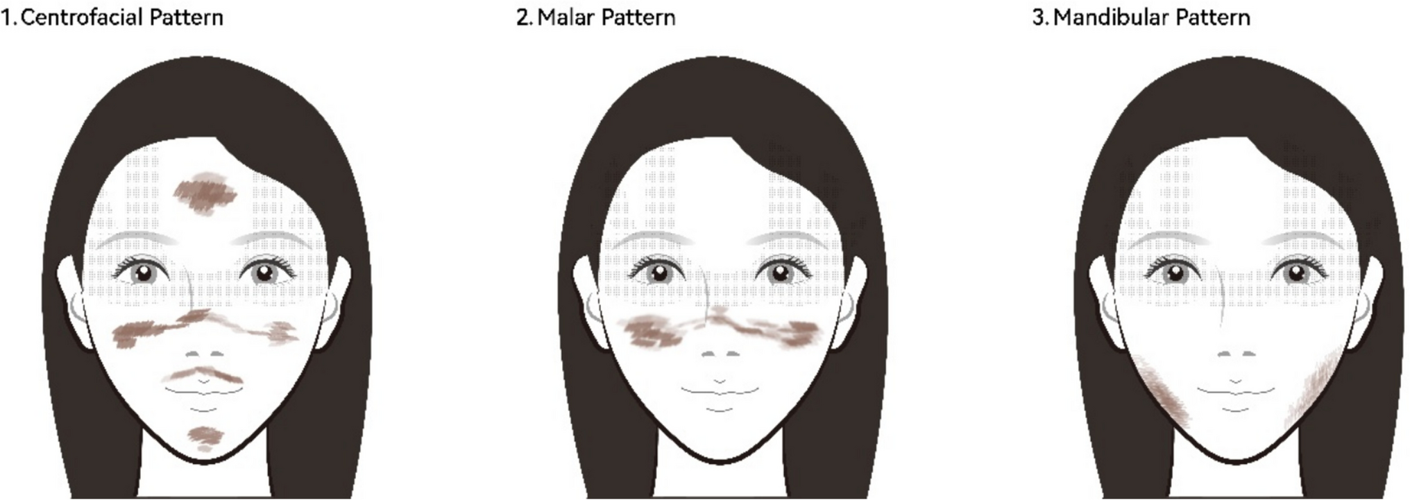Efficacy and safety of ultra-pulsed CO2 fractional laser (UP) for the treatment of periorbital static wrinkles