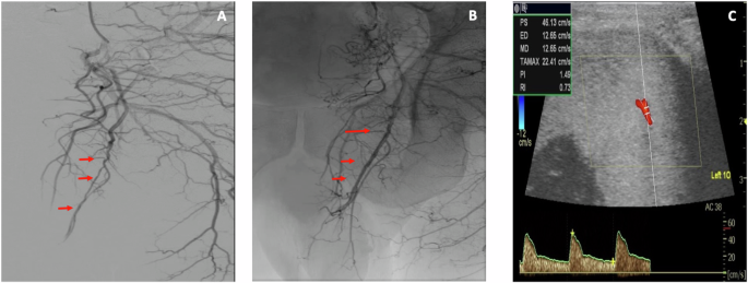 Percutaneous angioplasty of internal pudendal artery stenosis with drug-eluting paclitaxel-coated balloons for the treatment of severe erectile dysfunction: a single-center pilot experience