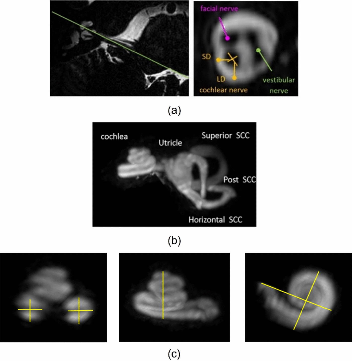 Morphology of the human inner ear and vestibulocochlear nerve assessed using 7 T MRI