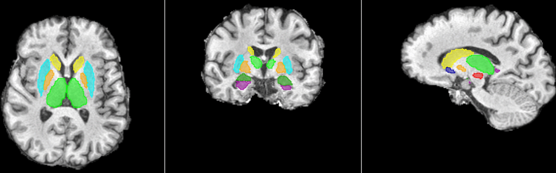 Enhancing MRI radiomics feature reproducibility and classification performance in Parkinson’s disease: a harmonization approach to gray-level discretization variability