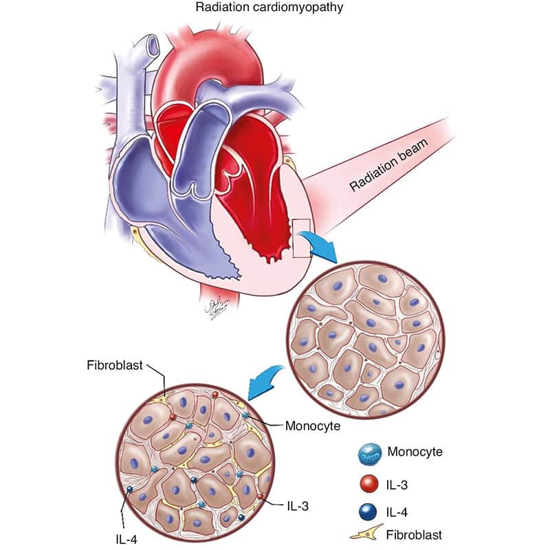 Comprehensive Strategies to Address Radiation-Induced Restrictive Cardiomyopathy