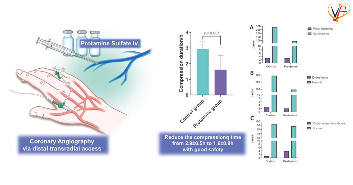 Intravenous Protamine Sulfate Shortens Compression Time After Coronary Angiography via Distal Transradial Access