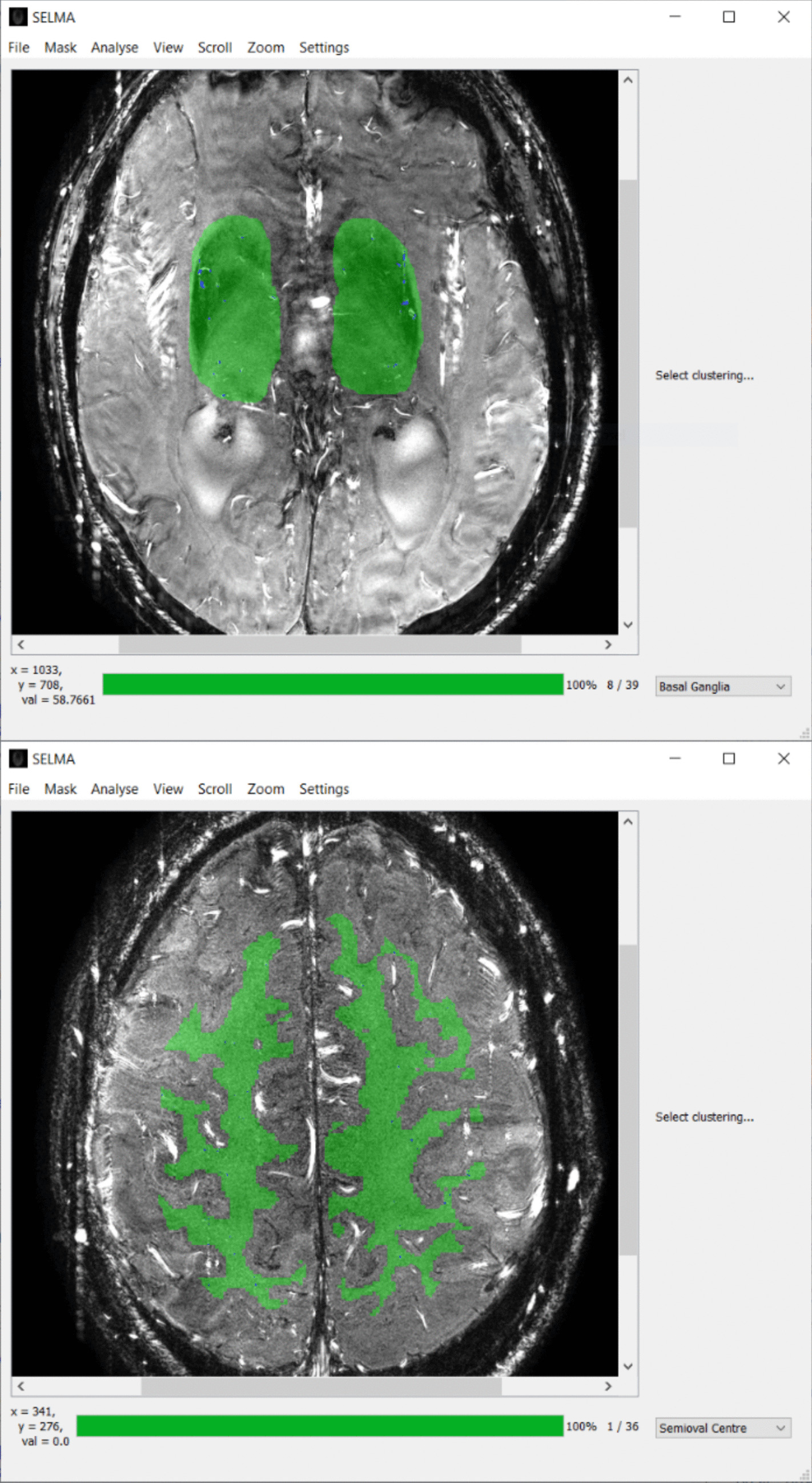 Blood Flow Velocity Analysis in Cerebral Perforating Arteries on 7T 2D Phase Contrast MRI with an Open-Source Software Tool (SELMA)